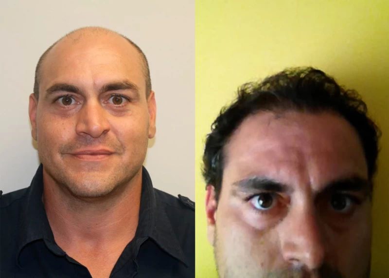 Patient 324 Hair Transplant Before and After