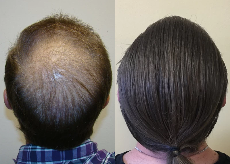 Patient p325 hair transplant before and after crown view