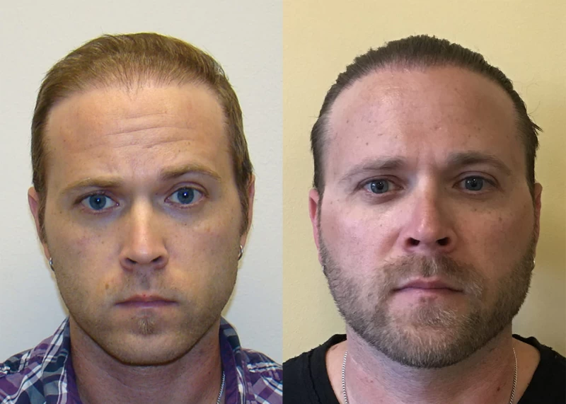 Patient 325 Hair Transplant Before and After
