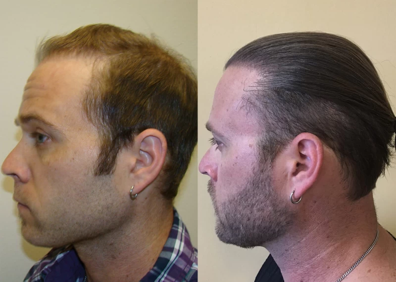 Patient p325 hair transplant before and after left view