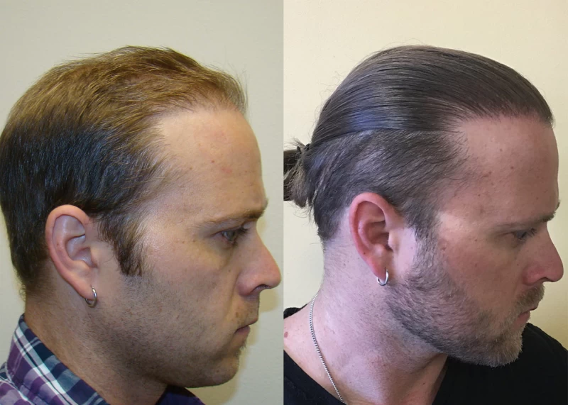 Patient p325 hair transplant before and after right view