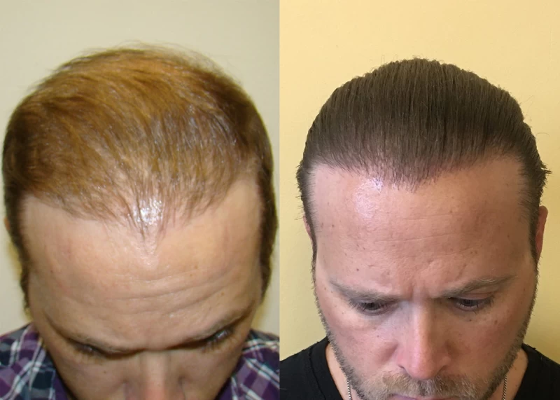 Patient p325 hair transplant before and after tilt view