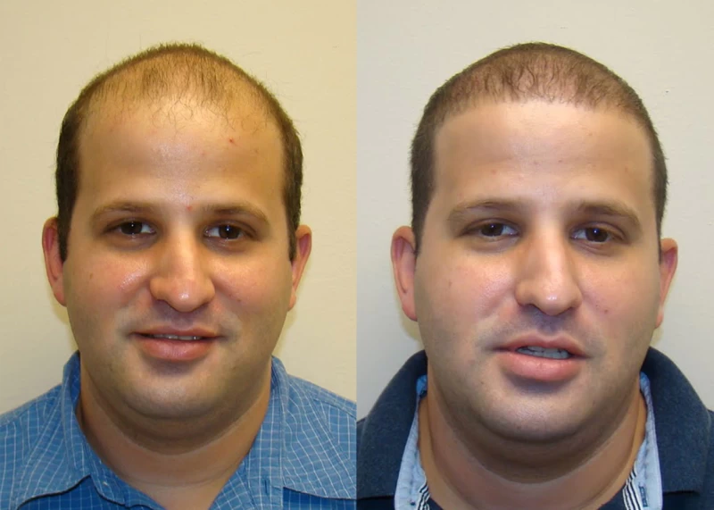 Patient 326 Hair Transplant Before and After