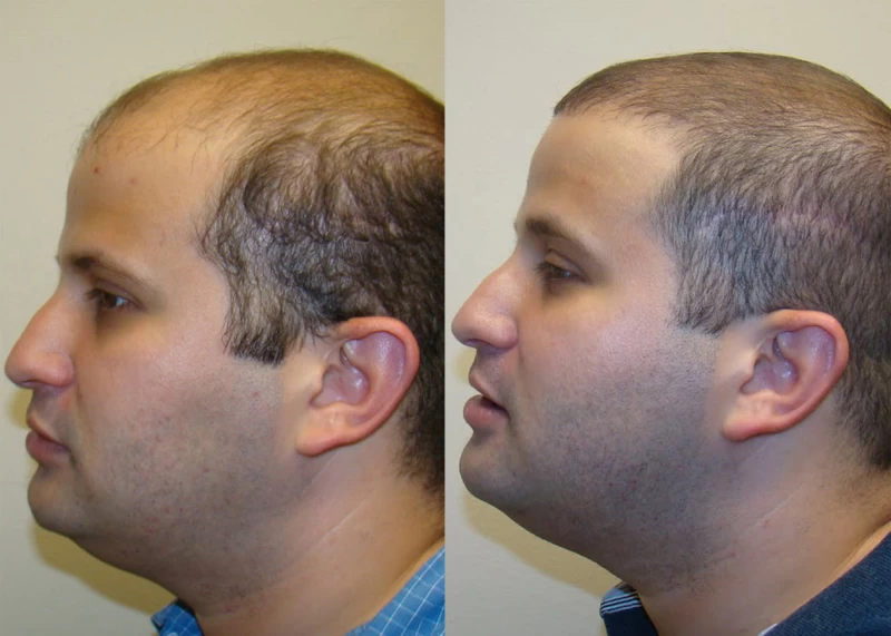 Patient p326 hair transplant before and after left view