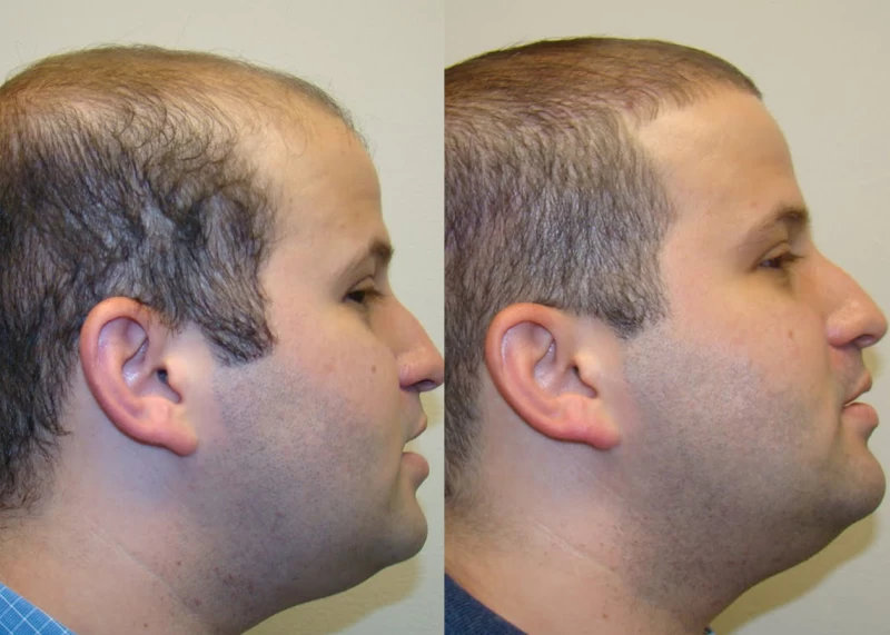 Patient p326 hair transplant before and after right view