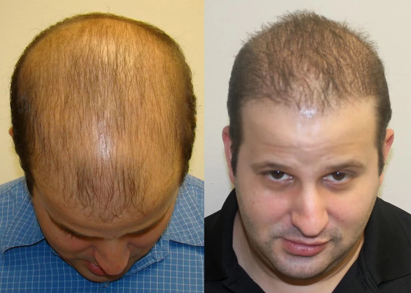 Patient p326 hair transplant before and after tilt view