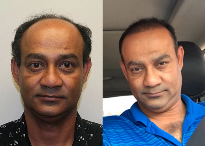 Patient 327 Hair Transplant Before and After