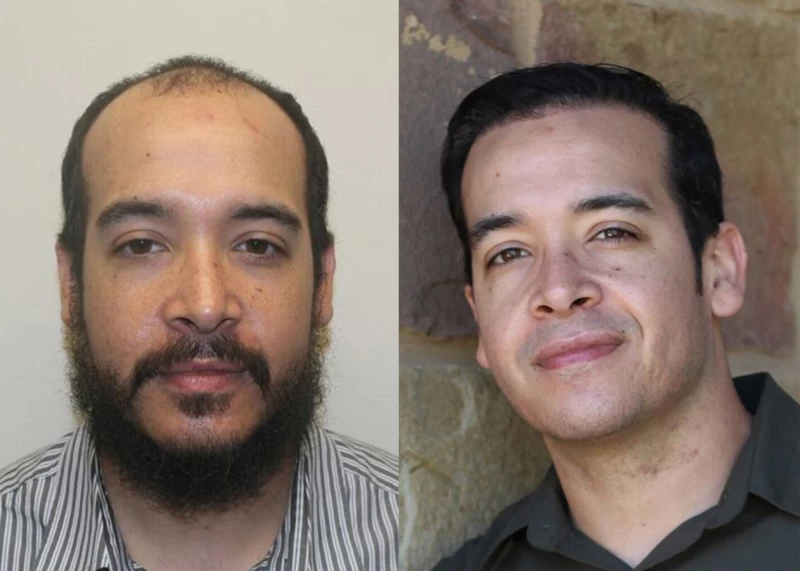 Patient 328 Hair Transplant Before and After