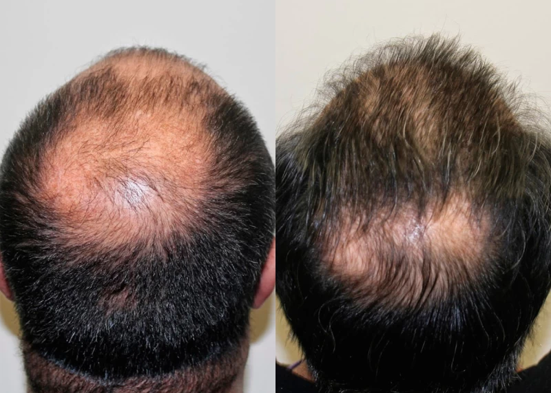 Patient p329 hair transplant before and after crown view