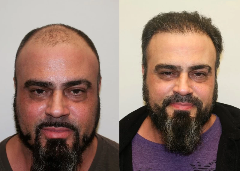 Patient 329 Hair Transplant Before and After