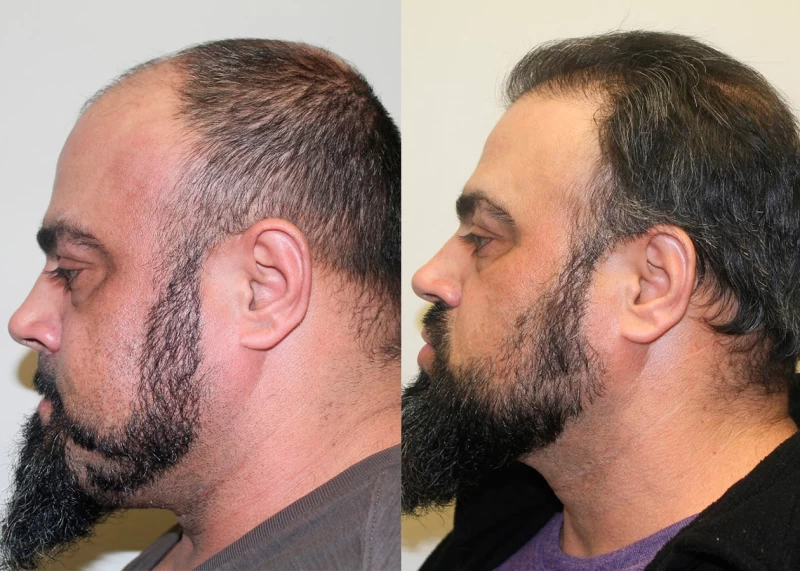 Patient p329 hair transplant before and after left view