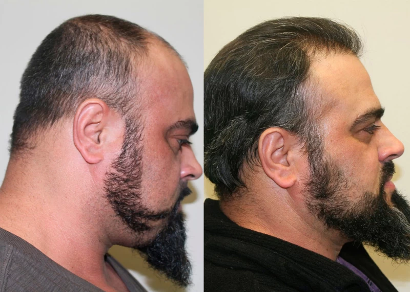 Patient p329 hair transplant before and after right view