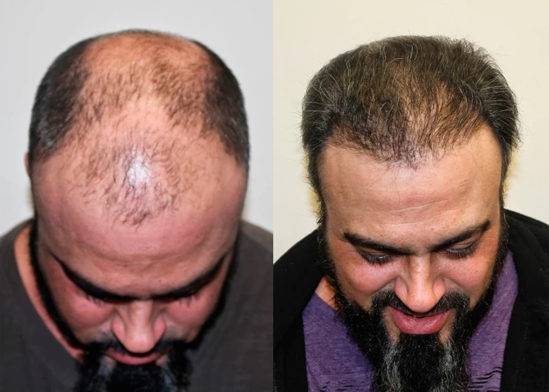 Patient p329 hair transplant before and after tilt view