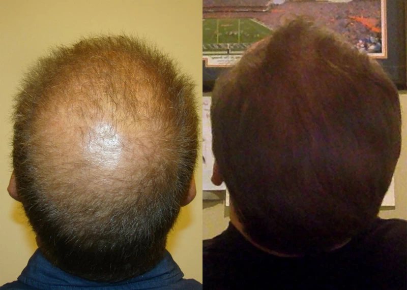 Patient p330 hair transplant before and after crown view