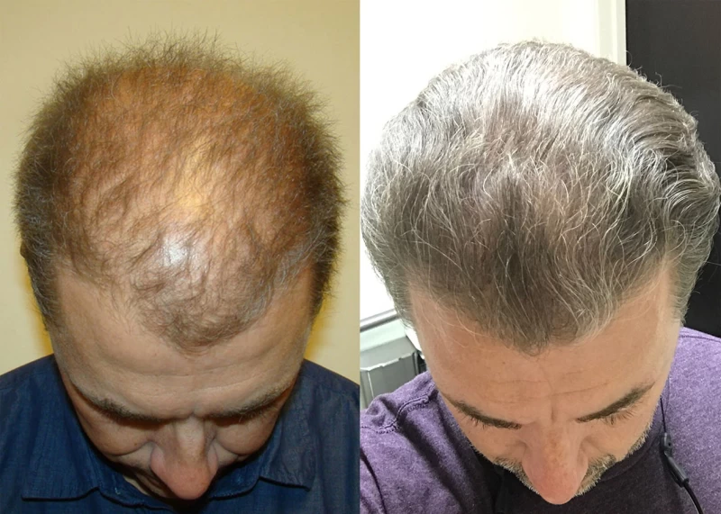 Patient 330 Hair Transplant Before and After