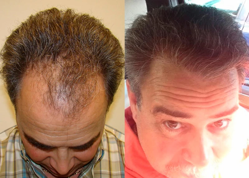 Patient 331 Hair Transplant Before and After