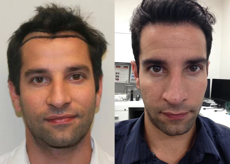 Patient 332 Hair Transplant Before and After
