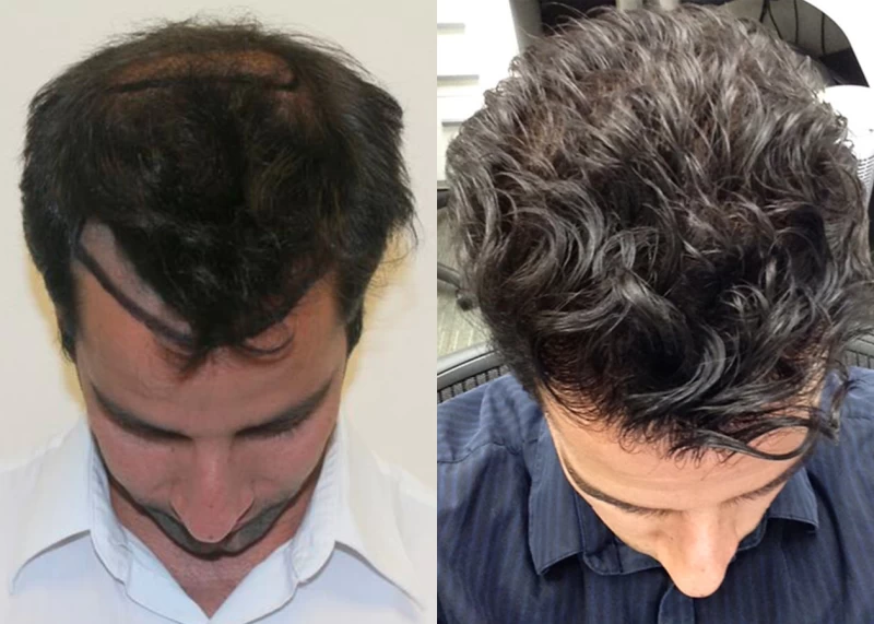 Patient p332 hair transplant before and after tilt view