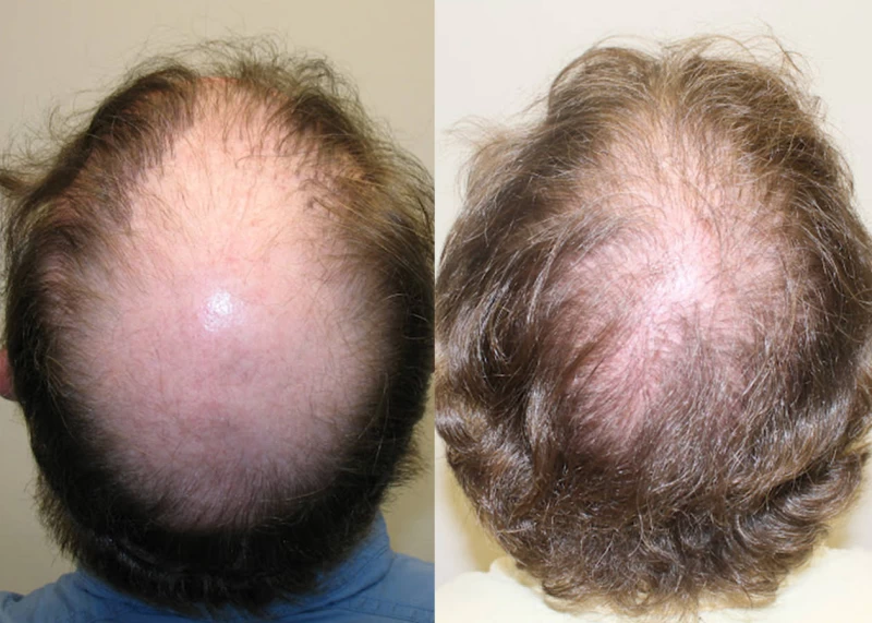 Patient p333 hair transplant before and after crown view