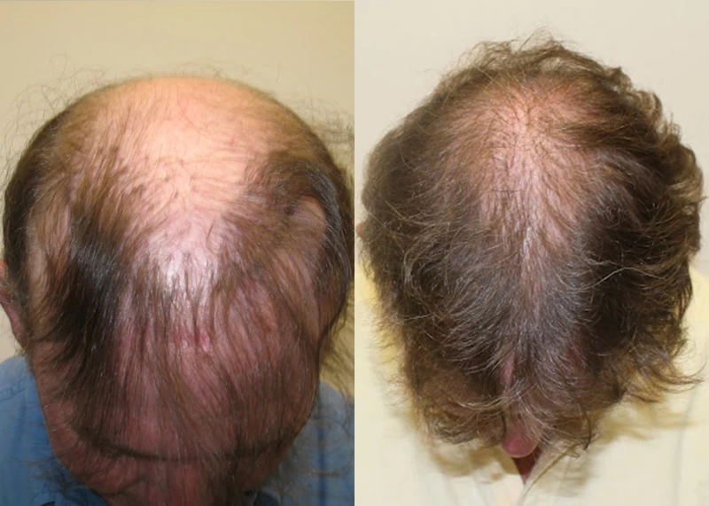 Patient 333 Hair Transplant Before and After