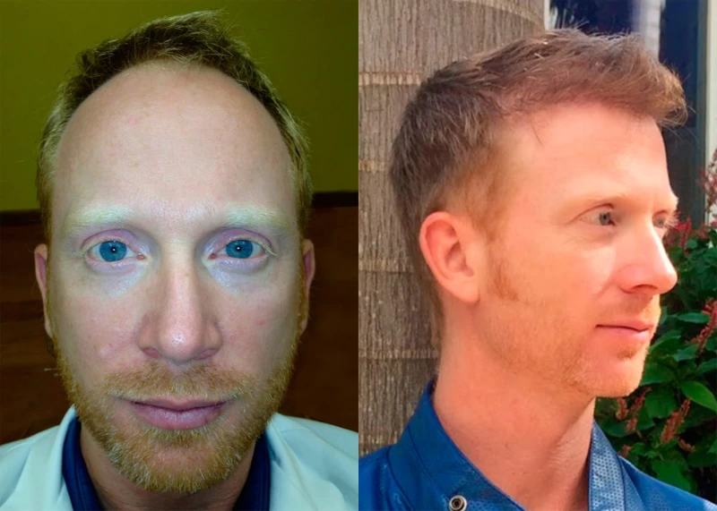 Patient 334 Hair Transplant Before and After