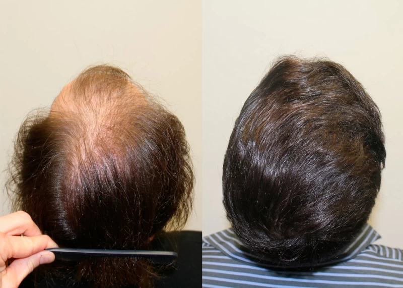 Patient p335 hair transplant before and after crown view