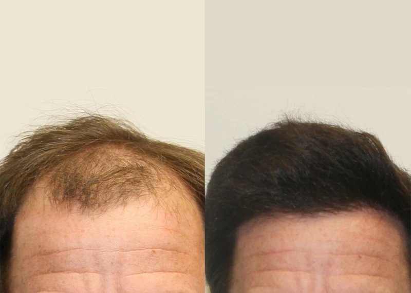 Patient 335 Hair Transplant Before and After