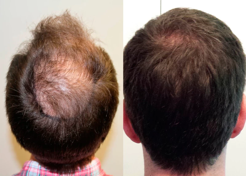 Patient p337 hair transplant before and after crown view