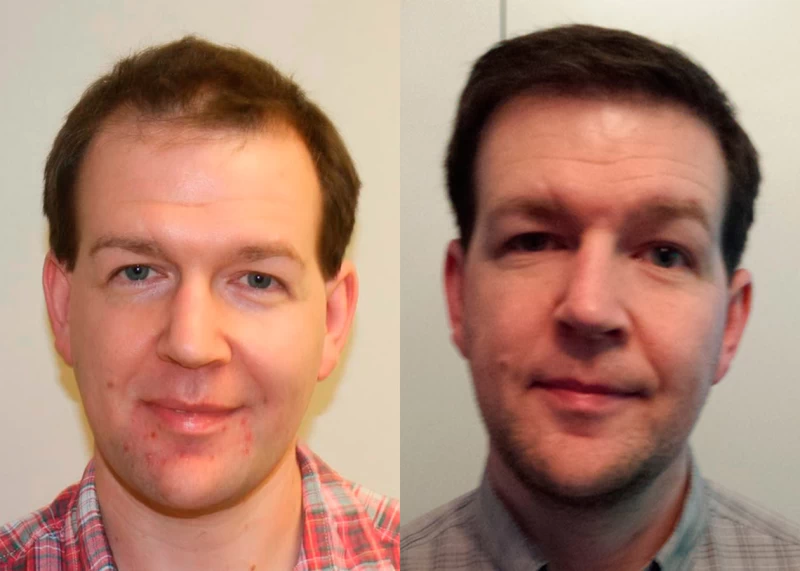 Patient 337 Hair Transplant Before and After