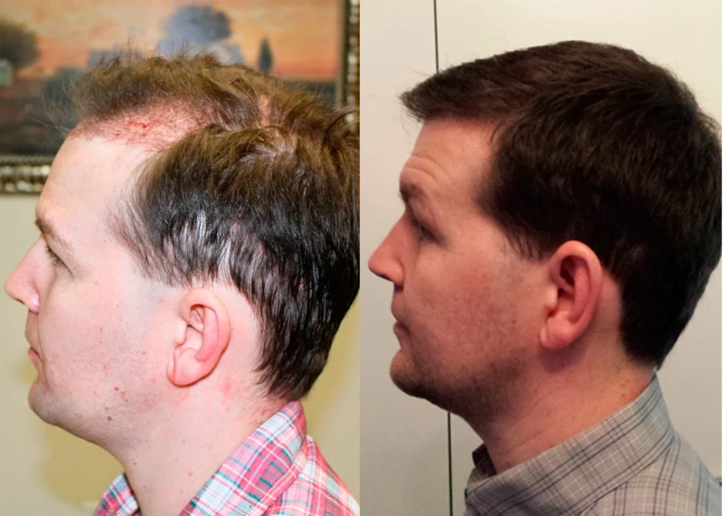 Patient p337 hair transplant before and after left view