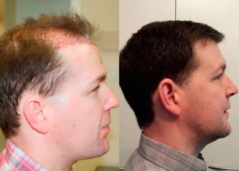 Patient p337 hair transplant before and after right view