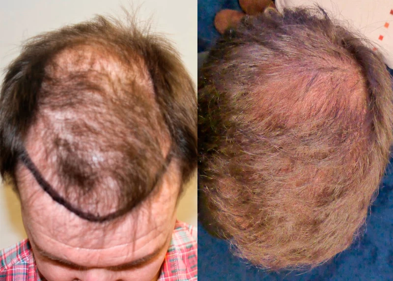Patient p337 hair transplant before and after tilt view