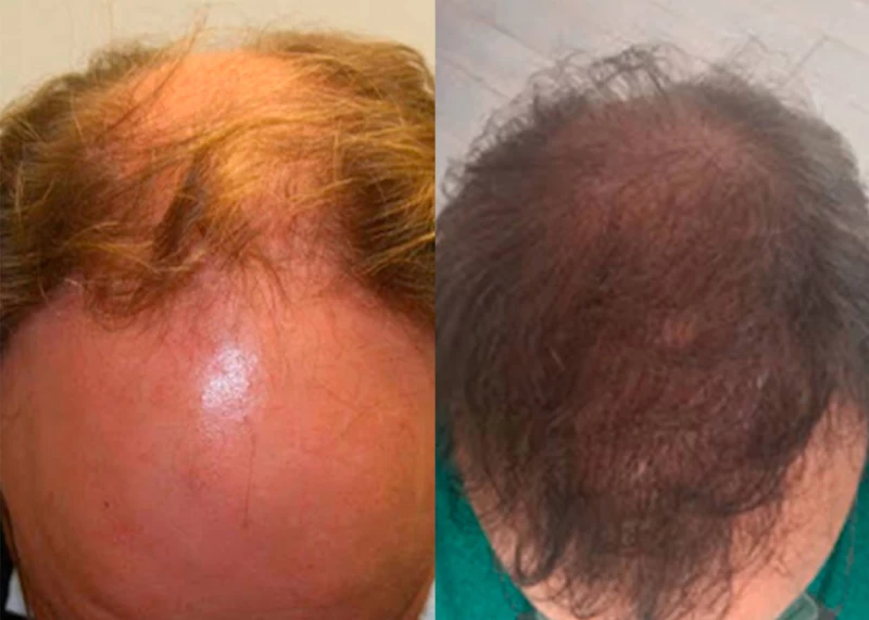 Patient 338 Hair Transplant Before and After