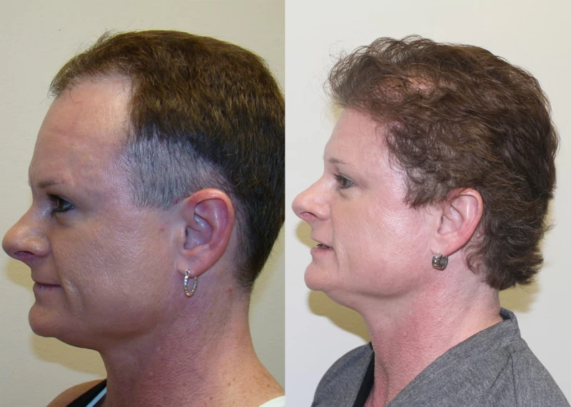 Patient p339 hair transplant before and after left view