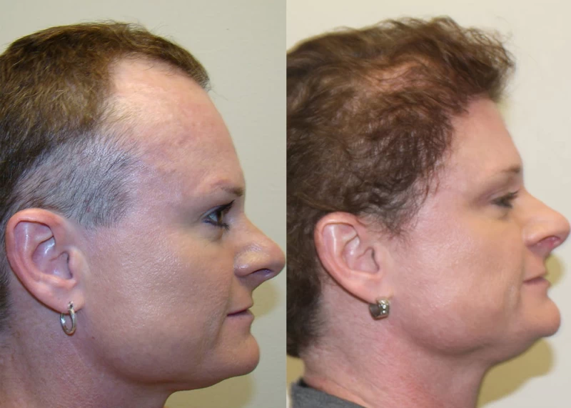 Patient p339 hair transplant before and after right view