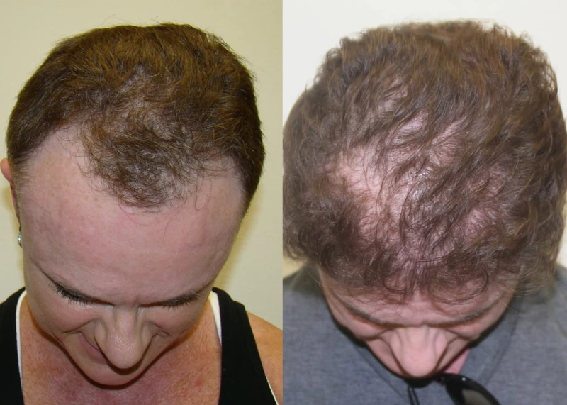 Patient 339 Hair Transplant Before and After