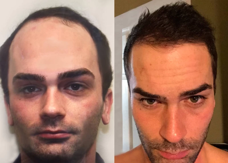 Patient 340 Hair Transplant Before and After
