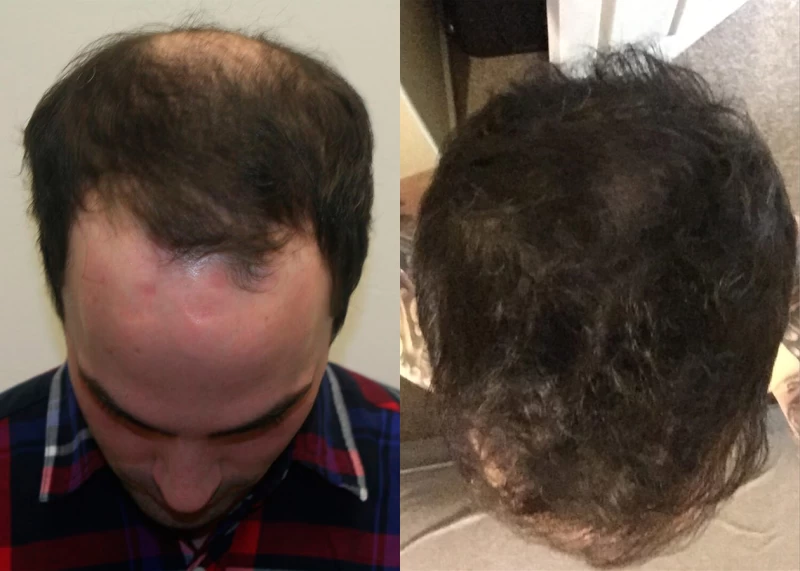 Patient p340 hair transplant before and after tilt view