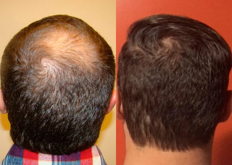 Patient p341 hair transplant before and after crown view