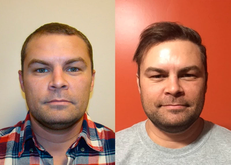Patient 341 Hair Transplant Before and After