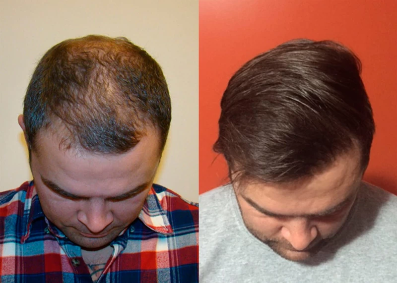 Patient p341 hair transplant before and after tilt view