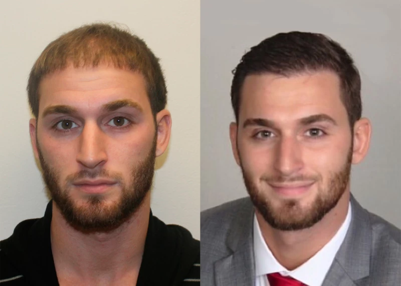 Patient 342 Hair Transplant Before and After