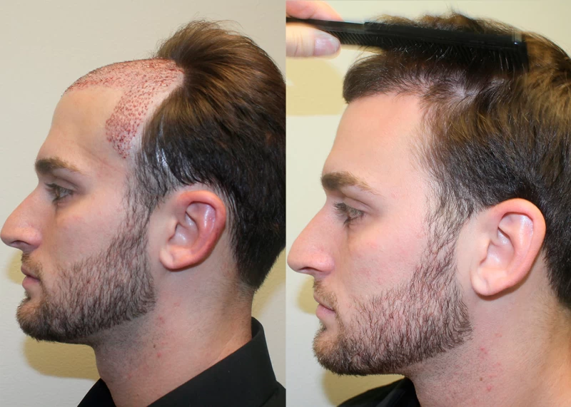 Patient p342 hair transplant before and after left view