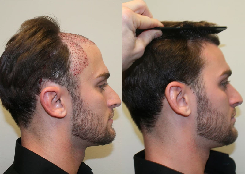 Patient p342 hair transplant before and after right view