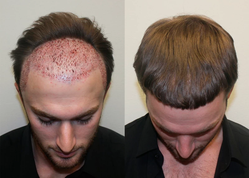 Patient p342 hair transplant before and after tilt view