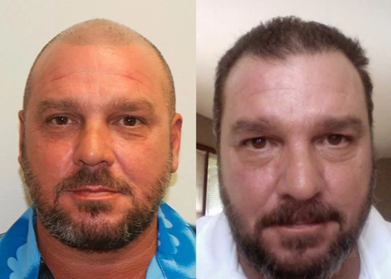 Patient 344 Hair Transplant Before and After