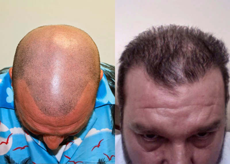 Patient p344 hair transplant before and after tilt view