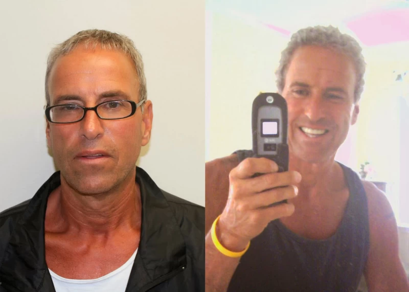 Patient 347 Hair Transplant Before and After