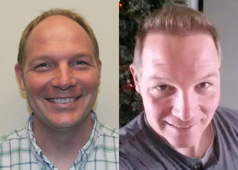 Patient 349 Hair Transplant Before and After