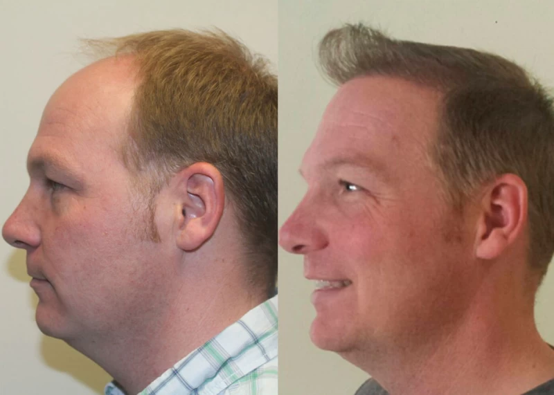 Patient p349 hair transplant before and after left view